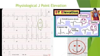 Jpoint Elev Comprehensive Guide to ECG Analysis: From Waves to Diagnosis | PPTX