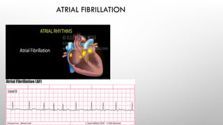 Comprehensive Overview of Cardiac Rhythms and ECG Abnormalities | PPTX