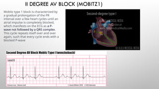Comprehensive Overview of Cardiac Rhythms and ECG Abnormalities | PPTX