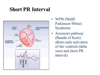 Short PR Interval
• WPW (Wolff-
Parkinson-White)
Syndrome
• Accessory pathway
(Bundle of Kent)
allows early activation
of the ventricle (delta
wave and short PR
interval)
 