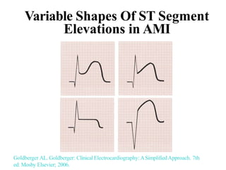 Variable Shapes Of ST Segment
Elevations in AMI
Goldberger AL. Goldberger: Clinical Electrocardiography:ASimplifiedApproach. 7th
ed: Mosby Elsevier; 2006.
 