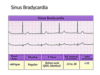 Sinus Bradycardia
 