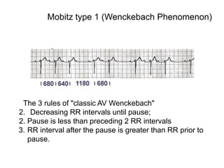 The 3 rules of "classic AV Wenckebach"
2. Decreasing RR intervals until pause;
2. Pause is less than preceding 2 RR intervals
3. RR interval after the pause is greater than RR prior to
pause.
Mobitz type 1 (Wenckebach Phenomenon)
 