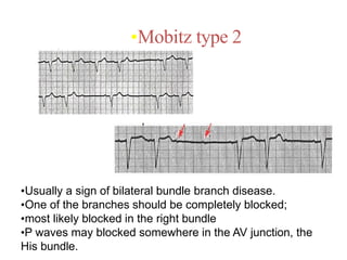 •Mobitz type 2
•Usually a sign of bilateral bundle branch disease.
•One of the branches should be completely blocked;
•most likely blocked in the right bundle
•P waves may blocked somewhere in the AV junction, the
His bundle.
 