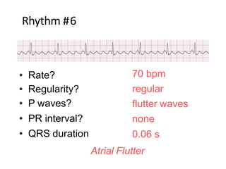 Rhythm #6
70 bpm
regular
flutter waves
none
0.06 s
• Rate?
• Regularity?
• P waves?
• PR interval?
• QRS duration?
Interpretation? Atrial Flutter
 
