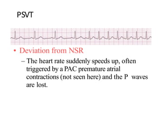 PSVT
• Deviation from NSR
– The heart rate suddenly speeds up, often
triggered by a PAC premature atrial
contractions (not seen here) and the P waves
are lost.
 