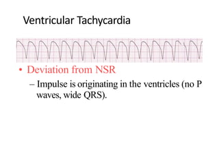 Ventricular Tachycardia
• Deviation from NSR
– Impulse is originating in the ventricles (no P
waves, wide QRS).
 