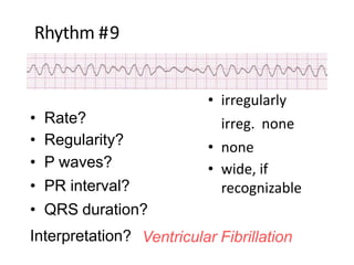 Rhythm #9
• none
• irregularly
irreg. none
• none
• wide, if
recognizable
• Rate?
• Regularity?
• P waves?
• PR interval?
• QRS duration?
Interpretation? Ventricular Fibrillation
 