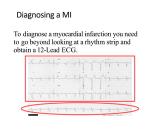 Diagnosing a MI
To diagnose a myocardial infarction you need
to go beyond looking at a rhythm strip and
obtain a 12-Lead ECG.
Rhythm
Strip
12-Lead
ECG
 