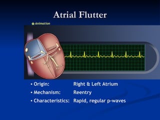 Ecg 3 | PPT