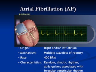 Animation Atria Ecg 3 | PPT