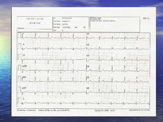 Ecg 4 | PPT