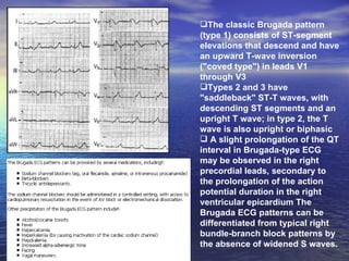 Ecg 4 | PPT