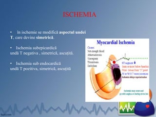 ISCHEMIA
• în ischemie se modifică aspectul undei
T, care devine simetrică.
• Ischemia subepicardică
undă T negativa , simetrică, ascuțită.
• Ischemia sub endocardică
undă T pozitiva, simetrică, ascuțită
 