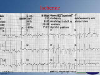 Ischemie
 
