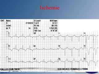 Ischemie
 