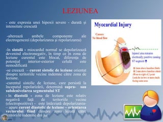 LEZIUNEA
- este expresia unei hipoxii severe - durată și
intensitate crescută
-alterează ambele componente ale
electrogenezei (depolarizarea şi repolarizarea)
-în sistolă - miocardul normal se depolarizează
devenind electronegativ, în timp ce în zona de
leziune curentul este blocat, diferența de
potențial interior-exterior celulă este
nemodificată
-se creează – curent sistolic de leziune orientat
dinspre teritoriile vecine indemne către zona de
leziune.
-curentul sistolic de leziune, care persistă la
începutul repolarizării, determină supra- sau
subdenivelarea segmentului ST
- în diastolă - zona de leziune este relativ
negativă faţă de teritoriile vecine
(electropozitive) - este întârziată depolarizarea-
– apare curent diastolic de leziune – orientarea
vectorului fiind dinspre zona lezată către
teritoriile indemne din jur 16
 