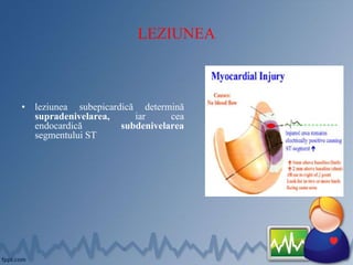 LEZIUNEA
• leziunea subepicardică determină
supradenivelarea, iar cea
endocardică subdenivelarea
segmentului ST
 