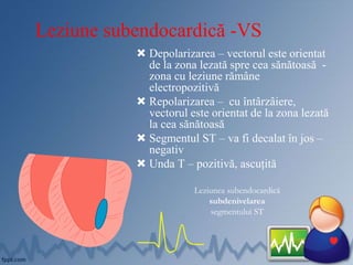 Leziune subendocardică -VS
 Depolarizarea – vectorul este orientat
de la zona lezată spre cea sănătoasă -
zona cu leziune rămâne
electropozitivă
 Repolarizarea – cu întârzâiere,
vectorul este orientat de la zona lezată
la cea sănătoasă
 Segmentul ST – va fi decalat în jos –
negativ
 Unda T – pozitivă, ascuțită
Leziunea subendocardică
subdenivelarea
segmentului ST
 