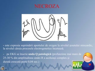 NECROZA
- este expresia suprimării aportului de oxigen la nivelul ţesutului miocardic,
la nivelul căruia procesele electrogenetice încetează.
- pe EKG se înscrie unda Q patologică (profunzime mai mare de
25-30 % din amplitudinea undei R a aceluiaşi complex şi
durată crescută peste 0,04 sec.)
20
 