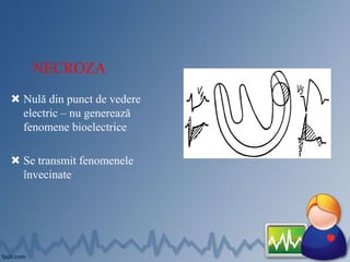 NECROZA
 Nulă din punct de vedere
electric – nu generează
fenomene bioelectrice
 Se transmit fenomenele
învecinate
 
