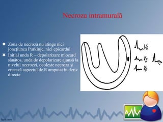 Necroza intramurală
 Zona de necroză nu atinge nici
joncțiunea Purkinje, nici epicardul
 Inițial unda R – depolarizare miocard
sănătos, unda de depolarizare ajunsă la
nivelul necrozei, ocolește necroza și
creează aspectul de R amputat în deriv
directe
 