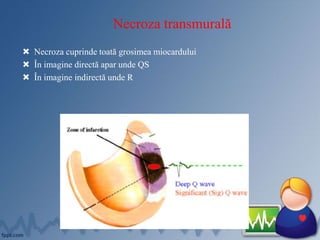 Necroza transmurală
 Necroza cuprinde toată grosimea miocardului
 În imagine directă apar unde QS
 În imagine indirectă unde R
 