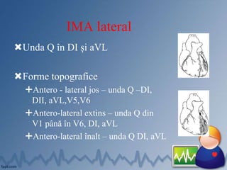 IMA lateral
Unda Q în DI și aVL
Forme topografice
Antero - lateral jos – unda Q –DI,
DII, aVL,V5,V6
Antero-lateral extins – unda Q din
V1 până în V6, DI, aVL
Antero-lateral înalt – unda Q DI, aVL
 