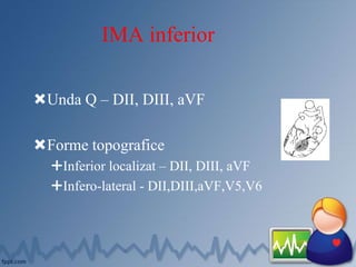 IMA inferior
Unda Q – DII, DIII, aVF
Forme topografice
Inferior localizat – DII, DIII, aVF
Infero-lateral - DII,DIII,aVF,V5,V6
 