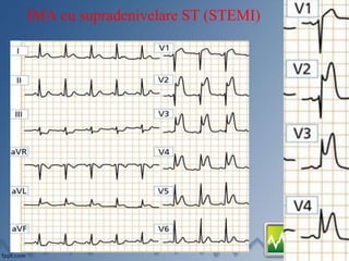 IMA cu supradenivelare ST (STEMI)
 