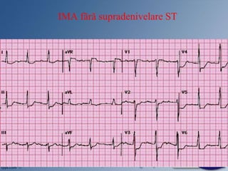 IMA fără supradenivelare ST
 
