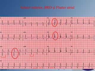 Infarct inferior, BRD și Flutter atrial
 