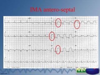 IMA antero-septal
 