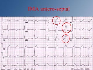 IMA antero-septal
 
