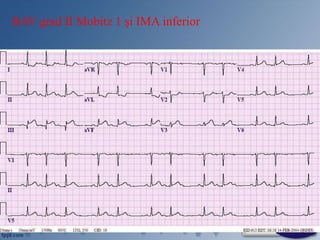 BAV grad II Mobitz 1 și IMA inferior
 