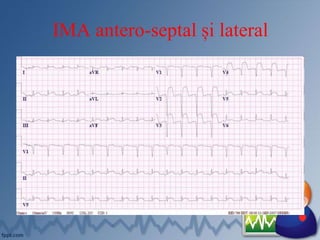 IMA antero-septal și lateral
 