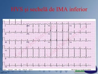 HVS și sechelă de IMA inferior
 