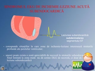 SINDROMUL EKG DE ISCHEMIE-LEZIUNE ACUTĂ
SUBENDOCARDICĂ
- corespunde situaţiilor în care zona de ischemie-leziune interesează straturile
profunde ale peretelui ventricular;
- uneori poate exista o zonă apreciabilă de necroză în straturile subendocardice, dar
fiind limitată la zona mută nu dă semne EKG de necroză, ci doar de ischemie-
leziune subendocardică.
65
Leziunea subendocardică
subdenivelarea
segmentului ST
 