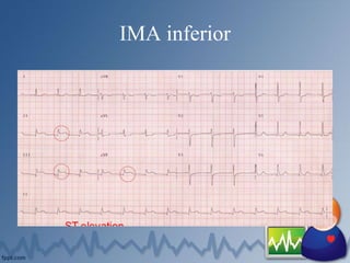 IMA inferior
 