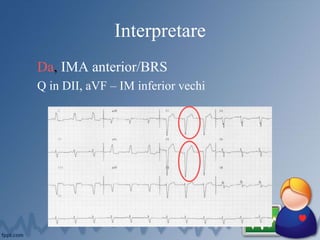 Interpretare
Da, IMA anterior/BRS
Q in DII, aVF – IM inferior vechi
 