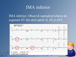 IMA inferior
IMA inferior. Observă supradenivelarea de
segment ST din derivațiile II, III și aVF.
 