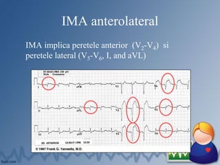 IMA anterolateral
IMA implica peretele anterior (V2-V4) si
peretele lateral (V5-V6, I, and aVL)
 