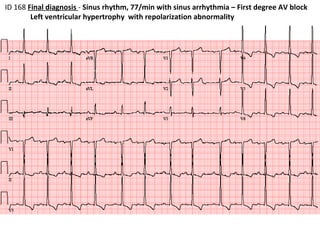 ID 168  Final diagnosis  -  Sinus rhythm, 77/min with sinus arrhythmia – First degree AV block Left ventricular hypertrophy  with repolarization abnormality  