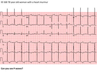 ID 168 78 year old woman with a heart murmur Can you see P waves? 