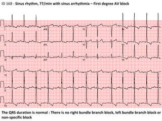 The QRS duration is normal : There is no right bundle branch block, left bundle branch block or non‐specific block  ID 168 -  Sinus rhythm, 77/min with sinus arrhythmia – First degree AV block  