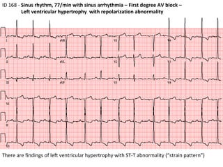 ID 168 -  Sinus rhythm, 77/min with sinus arrhythmia – First degree AV block – Left ventricular hypertrophy  with repolarization abnormality  There are findings of left ventricular hypertrophy with ST-T abnormality (“strain pattern”) 
