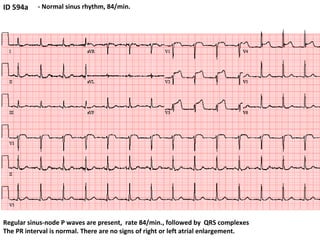 ID 594a - Normal sinus rhythm, 84/min. Regular sinus-node P waves are present,  rate 84/min., followed by  QRS complexes The PR interval is normal. There are no signs of right or left atrial enlargement.  