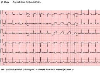 ID 594a - Normal sinus rhythm, 84/min. The QRS axis is normal  (+60 degrees) – The QRS duration is normal (90 msec.) -  