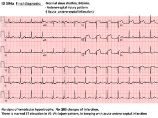 ID 594a  Final diagnosis:  Normal sinus rhythm, 84/min. Antero-septal injury pattern  (  Acute  antero-septal infarction) No signs of ventricular hypertrophy.  No QRS changes of infarction.  There is marked ST elevation in V1-V4: injury pattern, in keeping with acute antero-septal infarction  