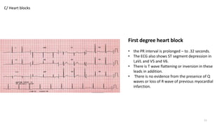 C/ Heart blocks
First degree heart block
• the PR interval is prolonged – to .32 seconds.
• The ECG also shows ST segment depression in
I,aVL and V5 and V6.
• There is T wave flattening or inversion in these
leads in addition.
• There is no evidence from the presence of Q
waves or loss of R wave of previous myocardial
infarction.
11
 